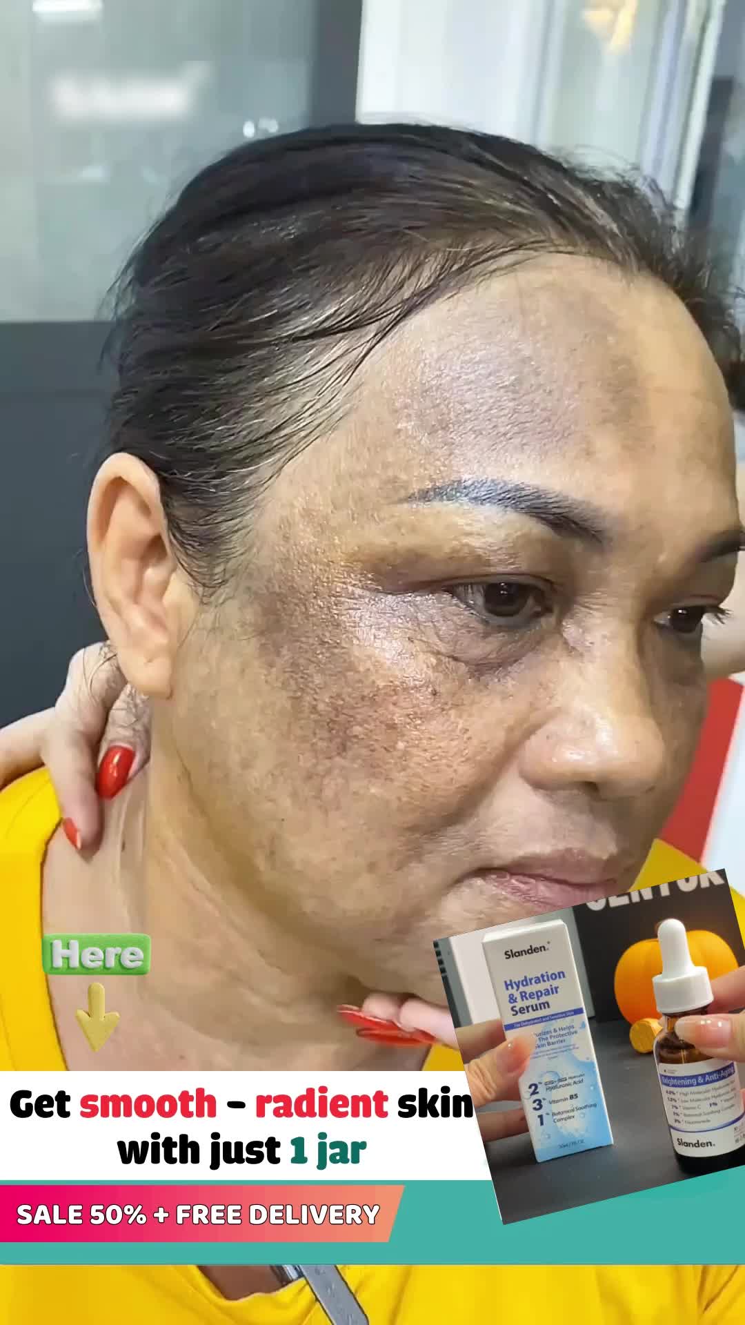 Try it now and see effective .#hyperpigmentation #darkspots #melasma #bigsale #pigmentation #wrinkles #acnescars #serum #chrismasgifts #slanden